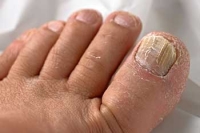 Do You Have Fungal Toenails?