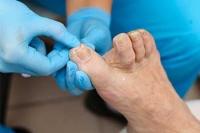 Treating Ingrown Toenails