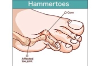 6 treatments for annoying hammertoes