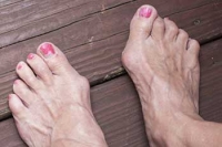Bunions