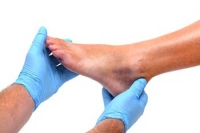 Foot lesions may be early sign of COVID-19 infection