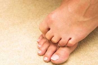 Hammertoes